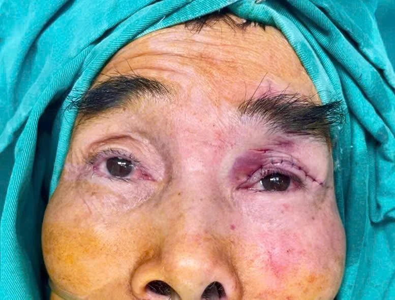 View - Tạo hình vạt cơ trán chữa mắt bị “che rèm” từ thuở lọt lòng ở cụ ông 65 tuổi | Báo Tri thức và Cuộc sống - TIN TỨC PHỔ BIẾN KIẾN THỨC 24H