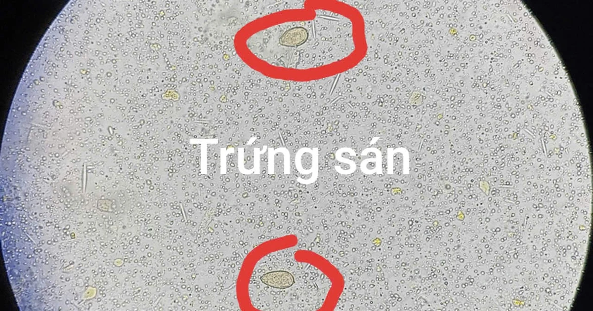 View - Thích ăn đồ tái sống, người đàn ông 64 tuổi bị sán lá gan gây tắc mật | Báo Tri thức và Cuộc sống - TIN TỨC PHỔ BIẾN KIẾN THỨC 24H