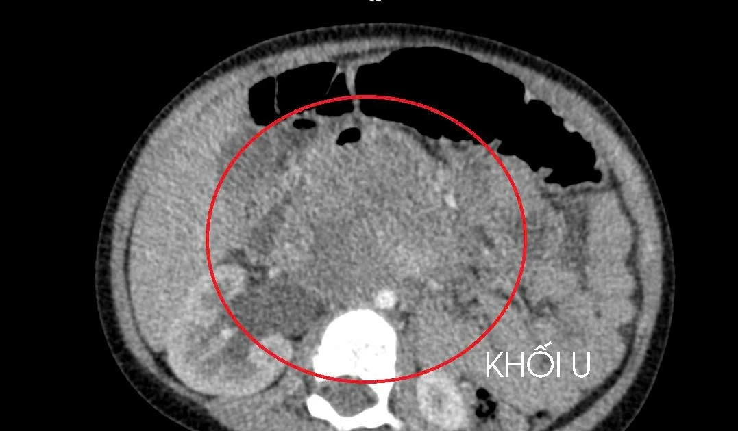 View - Bé 3 tuổi đã ung thư tinh hoàn, cha mẹ cần chú ý kiểm tra khi trẻ mới sinh | Báo Tri thức và Cuộc sống - TIN TỨC PHỔ BIẾN KIẾN THỨC 24H