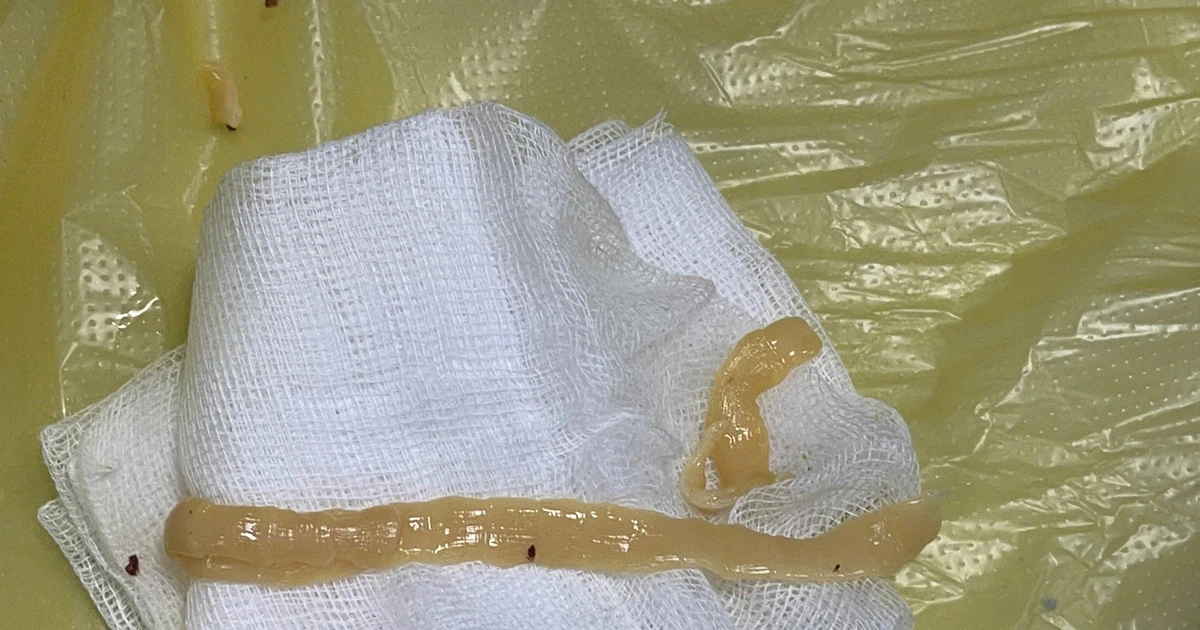 Gallery - Sán dây gần 1 mét 'ngọ nguậy' trong đại tràng người đàn ông thích ăn đồ tái | Báo Tri thức và Cuộc sống - TIN TỨC PHỔ BIẾN KIẾN THỨC 24H