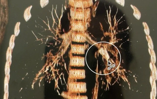 Gallery - Cứu sống bé 7 tuổi bị hóc đầu bút bi vào đường thở | Báo Tri thức và Cuộc sống - TIN TỨC PHỔ BIẾN KIẾN THỨC 24H