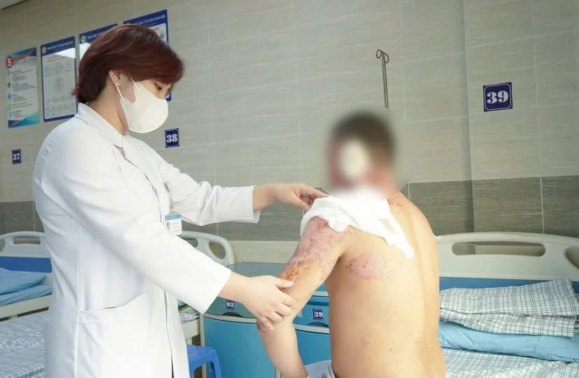 Bất cẩn lửa bén vào xăng khiến bỏng 9% diện tích cơ thể