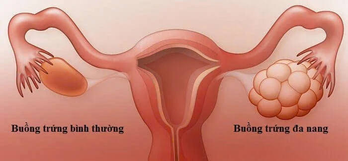 Đừng chủ quan với buồng trứng đa nang