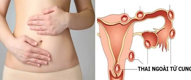 7 thói quen giúp phụ nữ giảm nguy cơ chửa ngoài tử cung