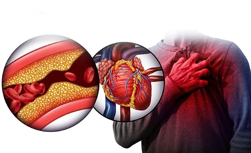 Nguy hiểm tiềm tàng từ mỡ trong máu cao, cách phòng tránh