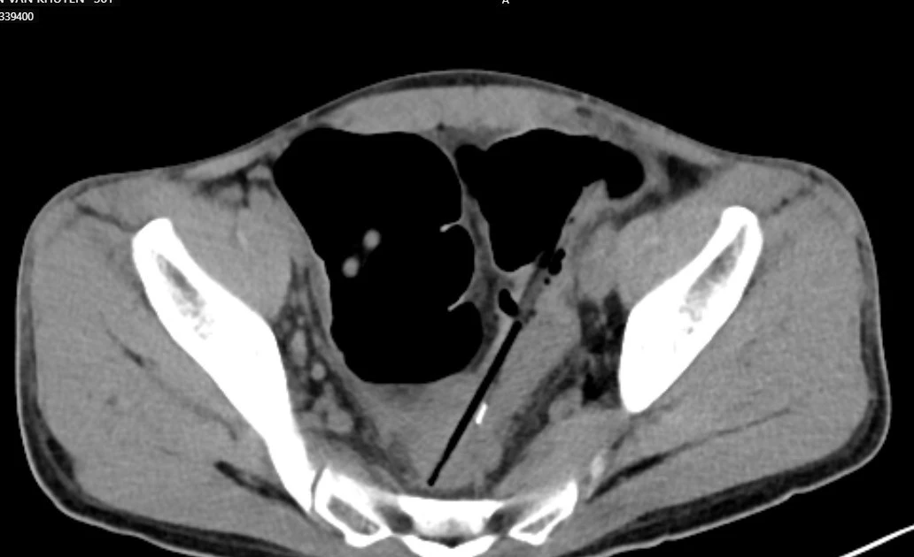 Mắc hội chứng Pica khiến người bệnh tự 'nuốt đủ thứ' vào bụng