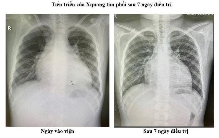 Bệnh nhi 11 tuổi thoát nguy kịch nhờ phác đồ điều trị suy tim mới