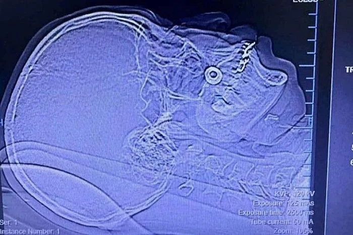 Tai nạn lao động hy hữu, người đàn ông bị rạn xương gò má