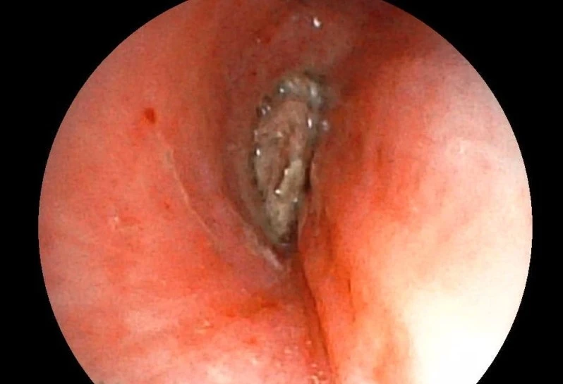 Nội soi gắp thành công dị vật hạt kha tử gây tắc đường thở nữ bệnh nhân