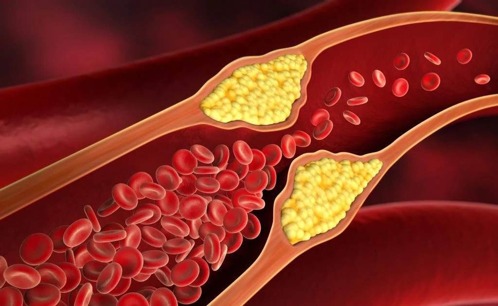 Hẹp động mạch cảnh, căn bệnh nguy hiểm khó nhận biết