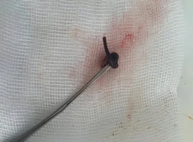 Vắt ký sinh trong mũi cô gái 21 tuổi gây nguy hiểm