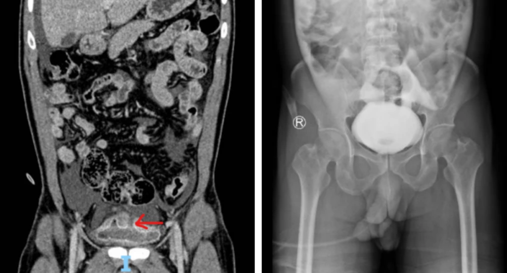 Cứu sống nam bệnh nhân 46 tuổi bị vỡ bàng quang hiếm gặp