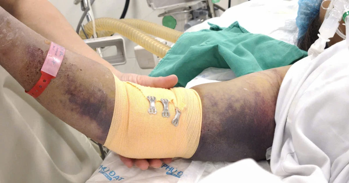 Nhiều ca sốc sốt xuất huyết dengue nguy kịch nhập viện