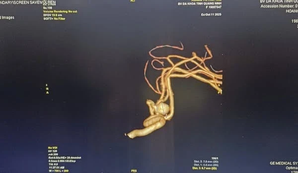 Đau đầu do tăng huyết áp, người phụ nữ 65 tuổi vỡ mạch máu não