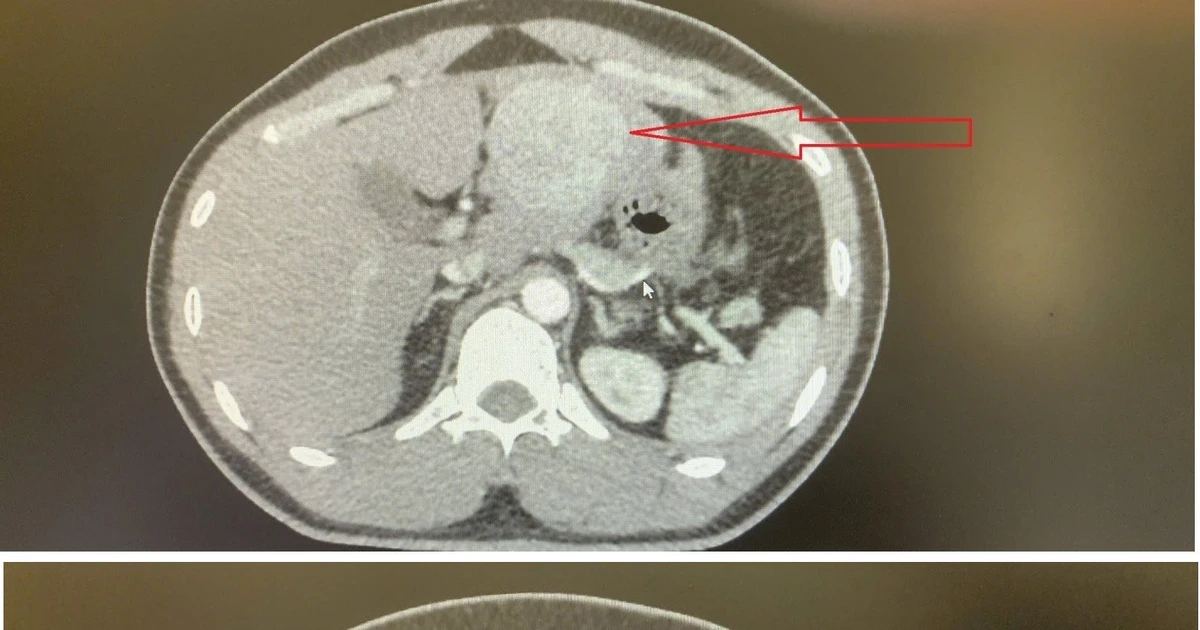 Đau bụng quanh rốn, chàng trai 35 tuổi không ngờ u gan chảy máu nguy kịch