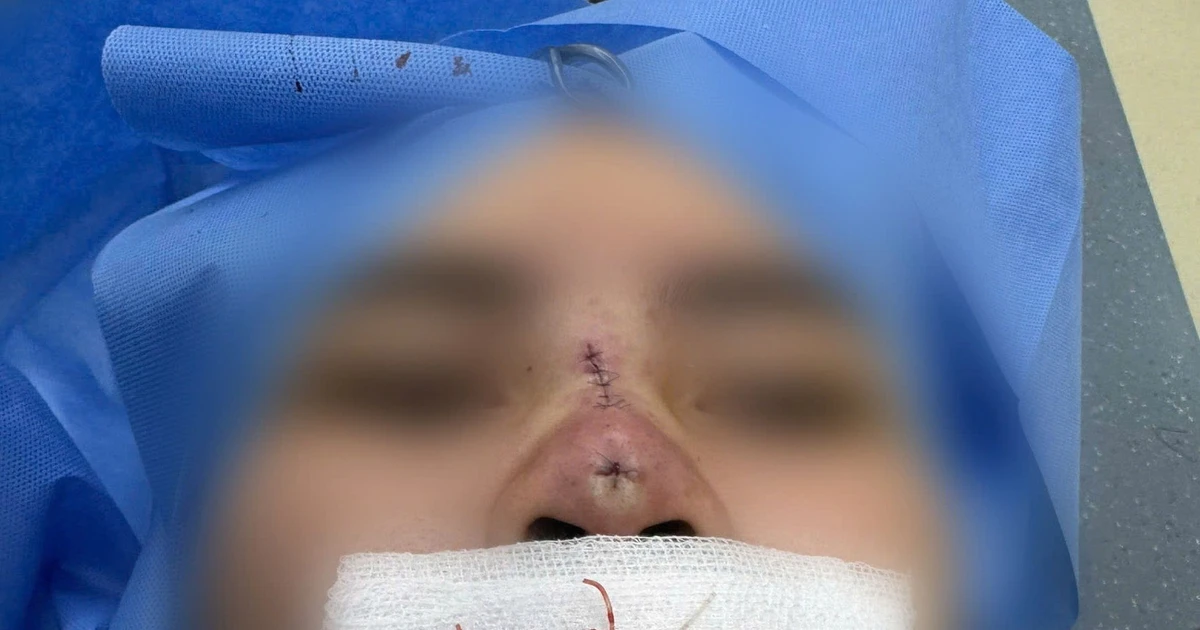 Cô gái 25 tuổi ở Hà Nội bị thủng mũi sau 3 tháng căng chỉ nâng mũi