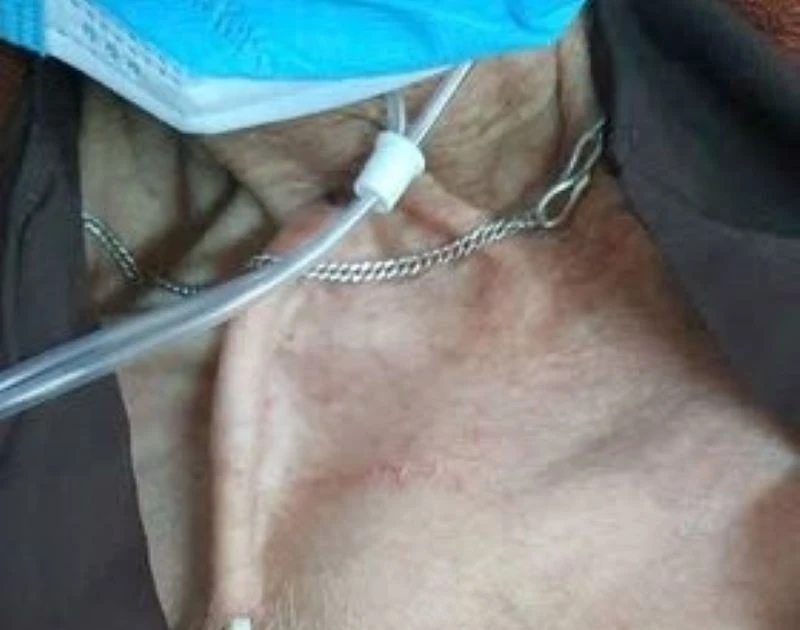 Tự cắt Catheter đường hầm lọc máu bệnh nhân chảy máu dữ dội