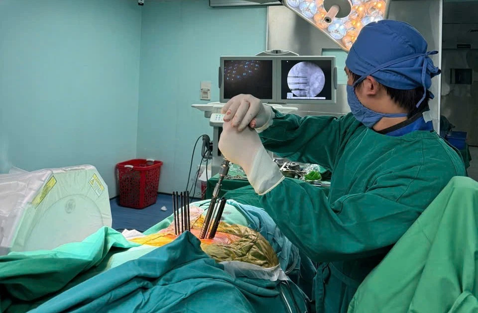 Bắt vít cột sống qua da cho người bệnh 59 tuổi bị vỡ đốt sống mất vững