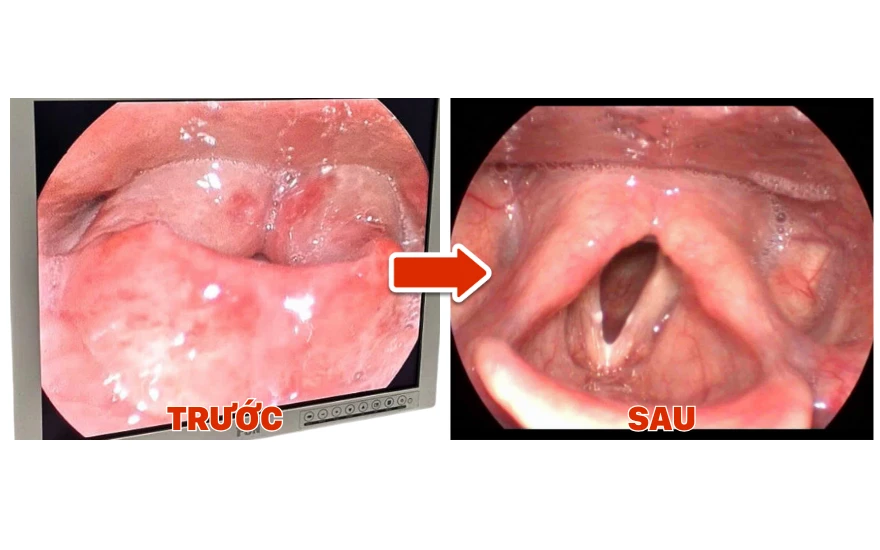 Một cơn đau họng cấp, người phụ nữ phù nề thanh quản đe dọa tính mạng