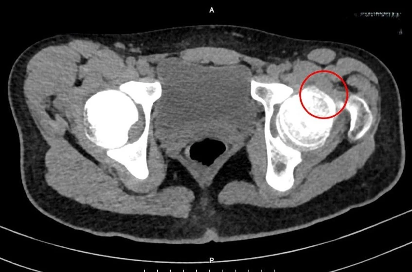 Nam sinh 14 tuổi mọc thêm xương ở khớp háng do hội chứng hiếm gặp