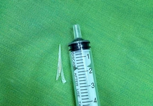 Lấy xương cá lớn 2 chạc trong thực quản người bệnh 49 tuổi