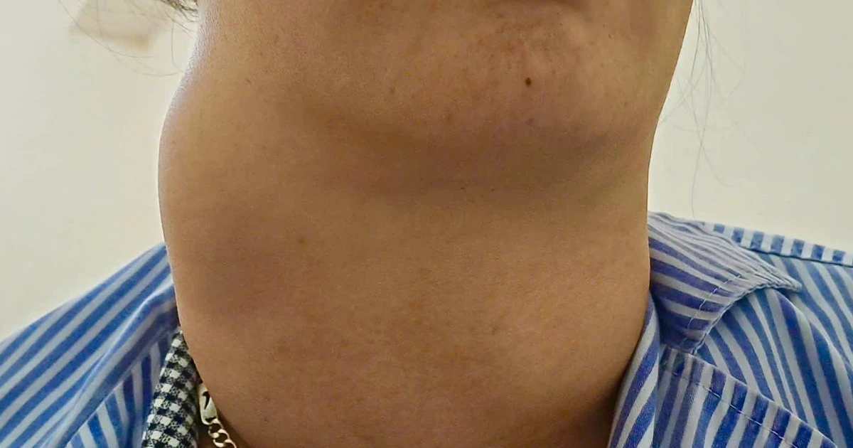 Người phụ nữ 41 tuổi bị bướu giáp khổng lồ đe dọa sự sống