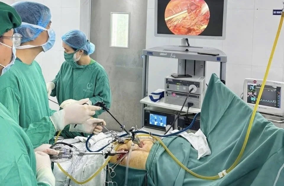 Lấy sỏi tái phát cho người tiền sử 3 lần phẫu thuật ổ bụng phức tạp