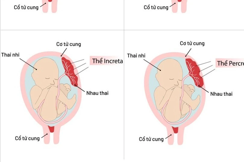 Bảo tồn tử cung cho sản phụ mắc rau cài răng lược đe dọa tính mạng