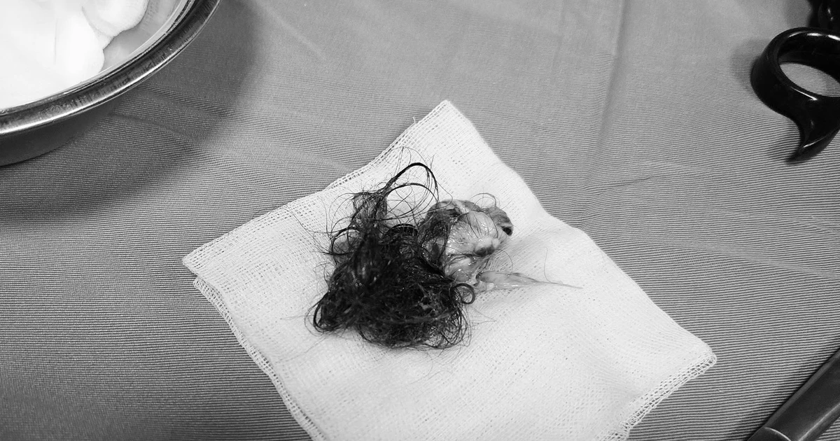 View - Lấy u buồng trứng xoắn chứa xương tóc, bảo toàn thai nhi | Báo Tri thức và Cuộc sống - TIN TỨC PHỔ BIẾN KIẾN THỨC 24H