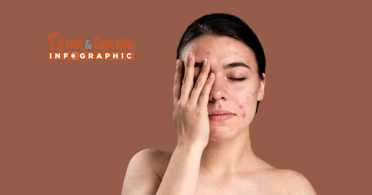 [INFOGRAPHIC] Bệnh về da thường gặp trong mùa hè