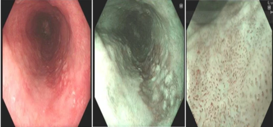 View - Nội soi trào ngược dạ dày, phát hiện tiền ung thư thực quản | Báo Tri thức và Cuộc sống - TIN TỨC PHỔ BIẾN KIẾN THỨC 24H