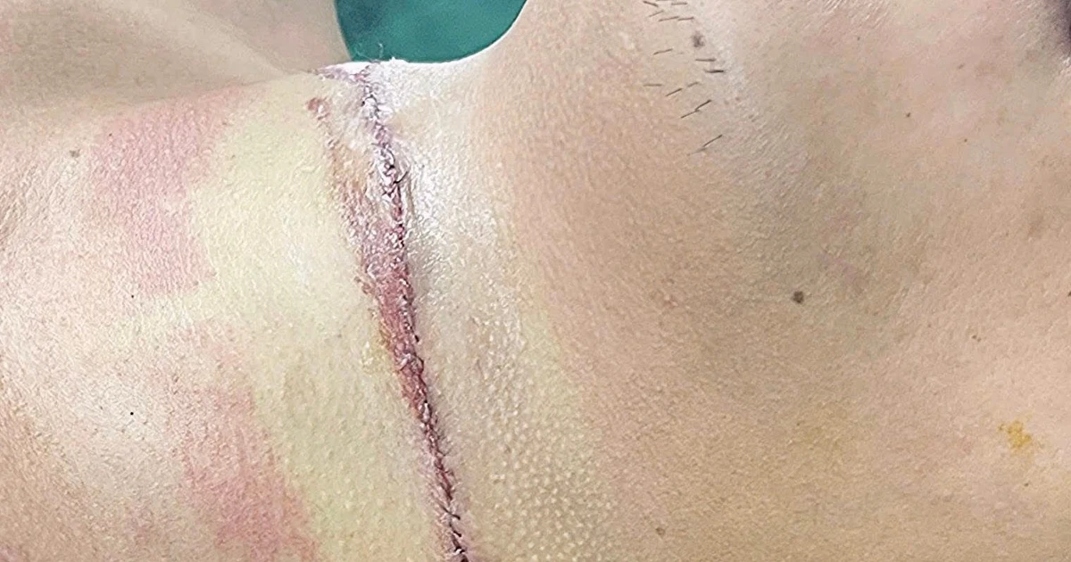 Bị dây thép trên đường cứa ngang cổ nguy kịch khi đi xe máy