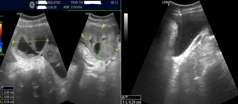 Gallery - Người phụ nữ trẻ phát hiện ung thư buồng trứng từ triệu chứng chướng bụng | Báo Tri thức và Cuộc sống - TIN TỨC PHỔ BIẾN KIẾN THỨC 24H