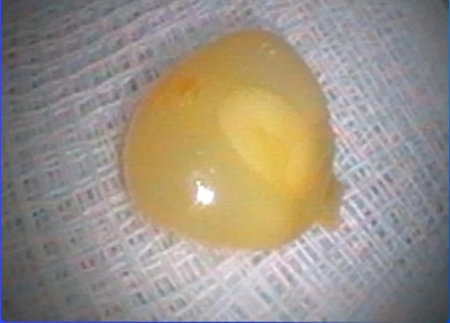 View - Cứu sống người phụ nữ bị sặc ngô, suy hô hấp nguy kịch | Báo Tri thức và Cuộc sống - TIN TỨC PHỔ BIẾN KIẾN THỨC 24H