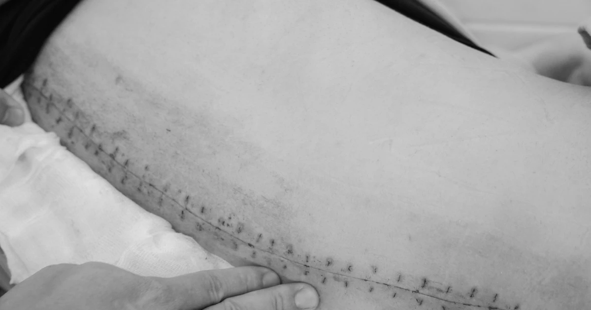 Gallery - Phẫu thuật thành công vẹo cột sống 53 độ cho nữ bệnh nhân 18 tuổi | Báo Tri thức và Cuộc sống - TIN TỨC PHỔ BIẾN KIẾN THỨC 24H