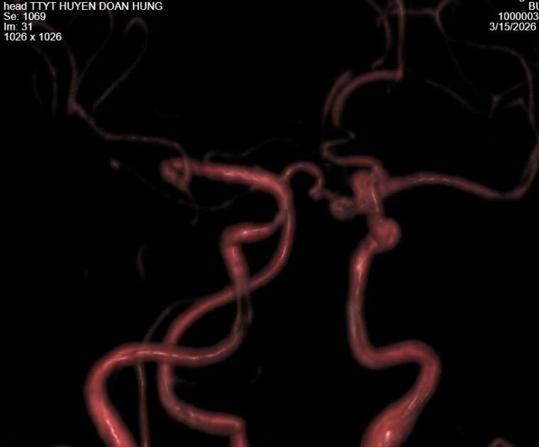 View - Chủ quan đau đầu có thể vỡ túi phình mạch máu não đe dọa tính mạng | Báo Tri thức và Cuộc sống - TIN TỨC PHỔ BIẾN KIẾN THỨC 24H