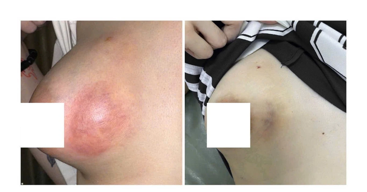 Cô gái 20 tuổi bị áp xe vú nặng sau tiêm filler không rõ nguồn gốc