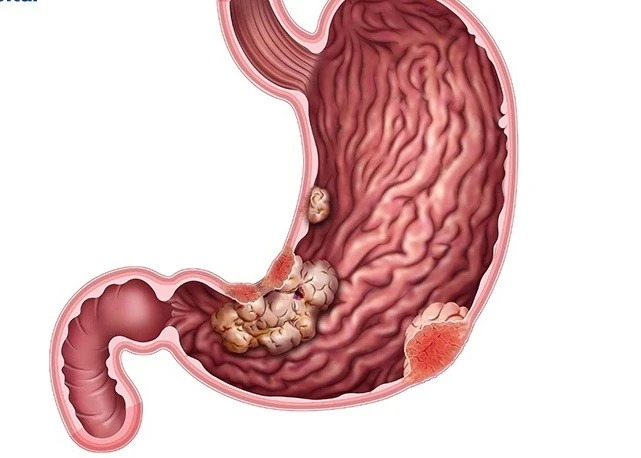 Người đàn ông phát hiện khối u mô đệm dạ dày hiếm gặp