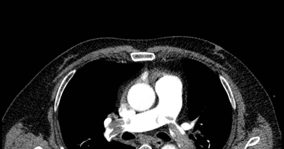 Cấp cứu thành công người bệnh thuyên tắc phổi nguy kịch
