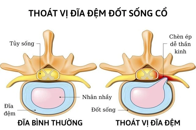 Phẫu thuật thoát vị đĩa đệm cột sống cổ giúp nam thanh niên thoát liệt