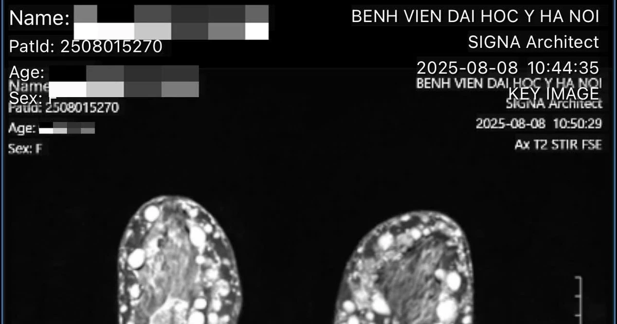 Người phụ nữ bị u hạt silicon ngực - biến chứng sau làm đẹp tại cơ sở 'chui'