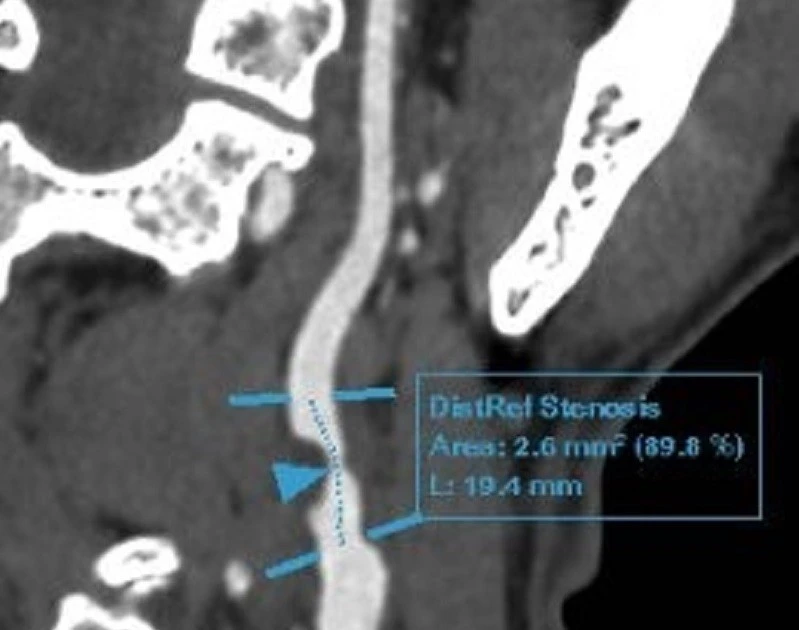 Người đàn ông hút thuốc lá 30 năm, phát hiện bệnh lý tim mạch nguy hiểm