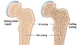 Nguyên nhân khiến nhiều người trẻ mắc bệnh loãng xương