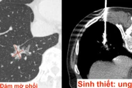 Cảnh báo, nhiều người chụp CT phổi kiểm tra sức khỏe phát hiện ung thư