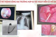 Ho sốt kéo dài ở trẻ 7 tháng do dị vật kim ghim bùa bình an trong cơ thể