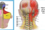 Đốt sống cao tần trị đau đầu xuất phát từ đốt sống cổ