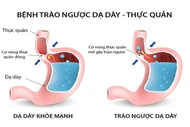 Thay đổi chế độ ăn uống chữa trào ngược dạ dày – thực quản