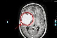 Đau đầu tưởng rối loạn tiền đình, nào ngờ khối u “khổng lồ” ăn mòn xương sọ