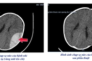 Ngã xe tập đi trẻ 8 tháng tuổi mở sọ cấp cứu giành lại sự sống