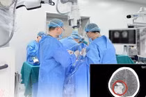 Cứu sản phụ mang thai tuần 19 đột quỵ do tiền sản giật